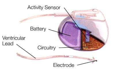 Figure 1: In a traditional pacemaker design, the battery takes up a significant area of the implantable device